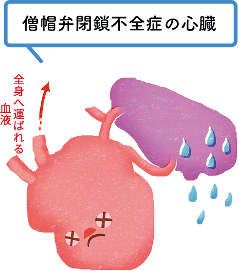 僧帽弁閉鎖不全症の心臓