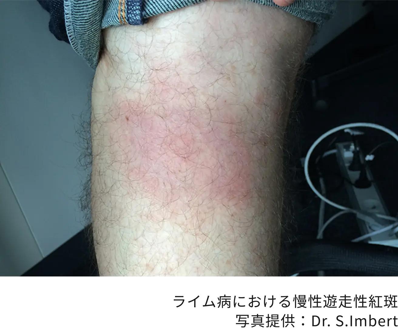 ライム病における慢性遊走性紅斑＿犬猫のマダニ被害画像